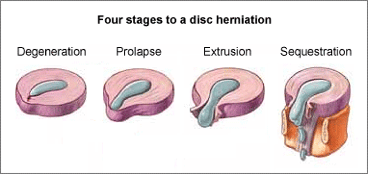 <p>1) Degeneration</p><p>Chemical change associated with ageing</p><p>Causes discs to weaken, but WITHOUT herniation</p><p>2) Prolapse</p><p>Protrusion of nucleus pulposus </p><p>Slight impingement into spinal canal </p><p>3) Extrusion</p><p>Nucleus pulposus breaks through the annulus fibrosus but remains WITHIN disc space</p><p>4) Sequestration</p><p>Nucleus pulposus breaks through annulus fibrosus and lies OUTSIDE disc space</p>