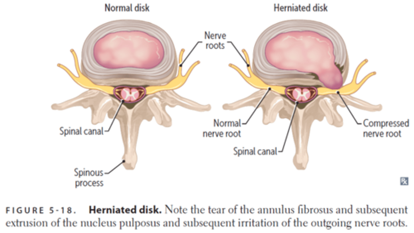 <p>trauma can cause annulus tears, end plate injuries, and annulus bruising</p><p>- bleeding mixes with inflammatory and immune mediators, which chemically irritate the dorsal root ganglion</p><p>- these chemical mediators can also remove myelin from adjacent axons, increasing sensitivity of the nerve</p>