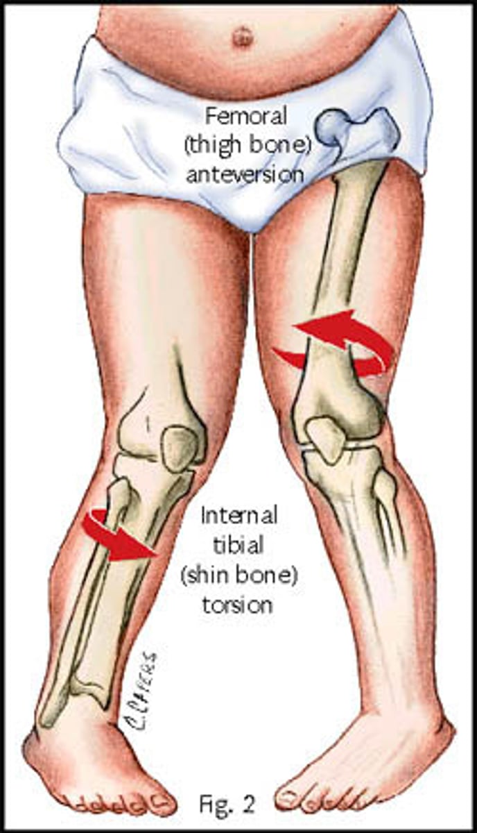 <p>Tibial Torsion</p><p>•Leg looks rotated relative to thigh</p><p>•Usually lateral torsion</p><p>•Patient is supine with patella facing upwards</p><p>•Line bisects the medial and lateral malleoli</p><p>•The angle from that line to horizontal line is measured</p><p>•Angles greater than 20-25 degrees is positive sign</p>