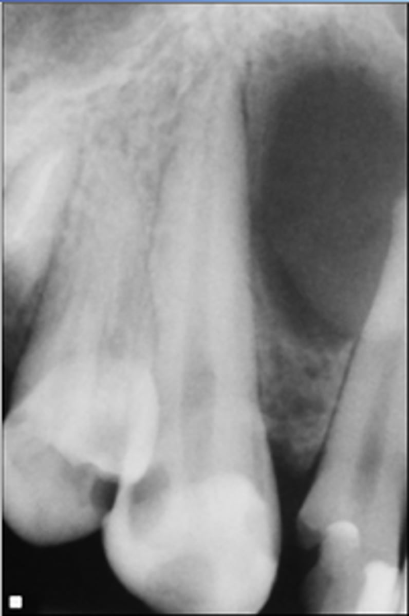 <p>ID the cyst (tooth is non-vital):</p>