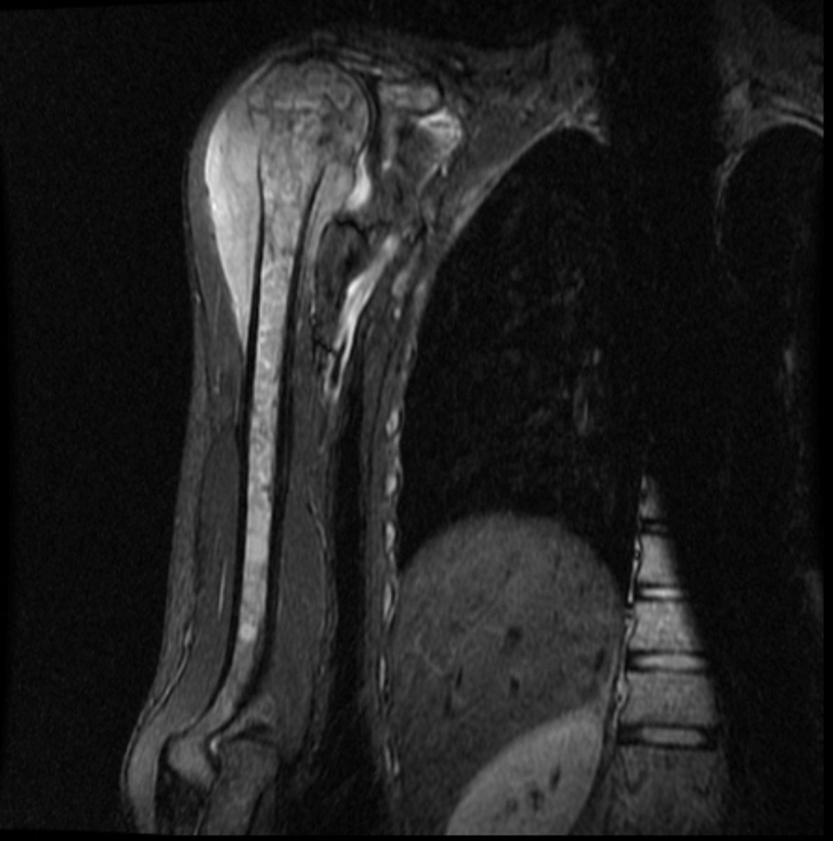 <p>Is there soft tissue extension/involvement?</p>