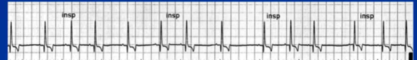 <p>Identify the type of arrhythmia?</p>