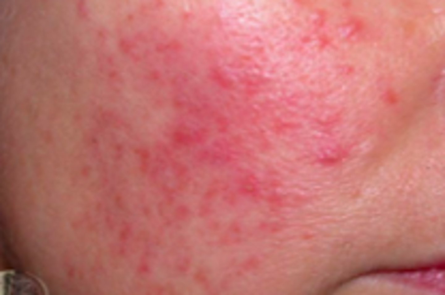 <p>Acneiform Disorders:</p><p>Overview:</p><p>- Common with unknown etiology</p><p>- Possible genetic predisposition</p><p>- Adults between 30-50 years of age</p><p>- More females than males</p><p>- More commonly diagnosed in individuals with fair skin</p>