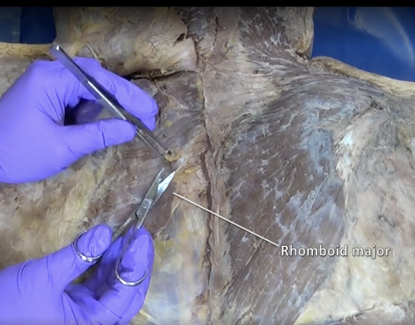 <p>elevation and retraction of scapula</p>