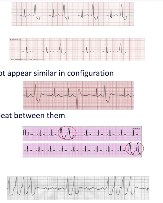 <p>PVC Variations:</p><ul><li><p>Bigeminy =</p></li><li><p>Trigeminy =</p></li><li><p>Multifocal PVC =</p><ul><li><p>What should PT do?</p></li></ul></li><li><p>Couplet =</p><ul><li><p>What should PT do?</p></li><li><p>If 2 or more couplets =</p></li></ul></li><li><p>3 or more PVC in a row =</p><ul><li><p>What should PT do?</p></li></ul></li></ul><p></p>