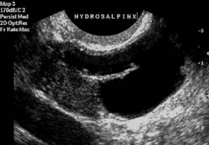<ul><li><p>Fluid or pus in the fallopian tubes</p></li><li><p>Associated with <strong>PID</strong></p></li><li><p>Suspicious for sexual abuse</p></li></ul><p></p>