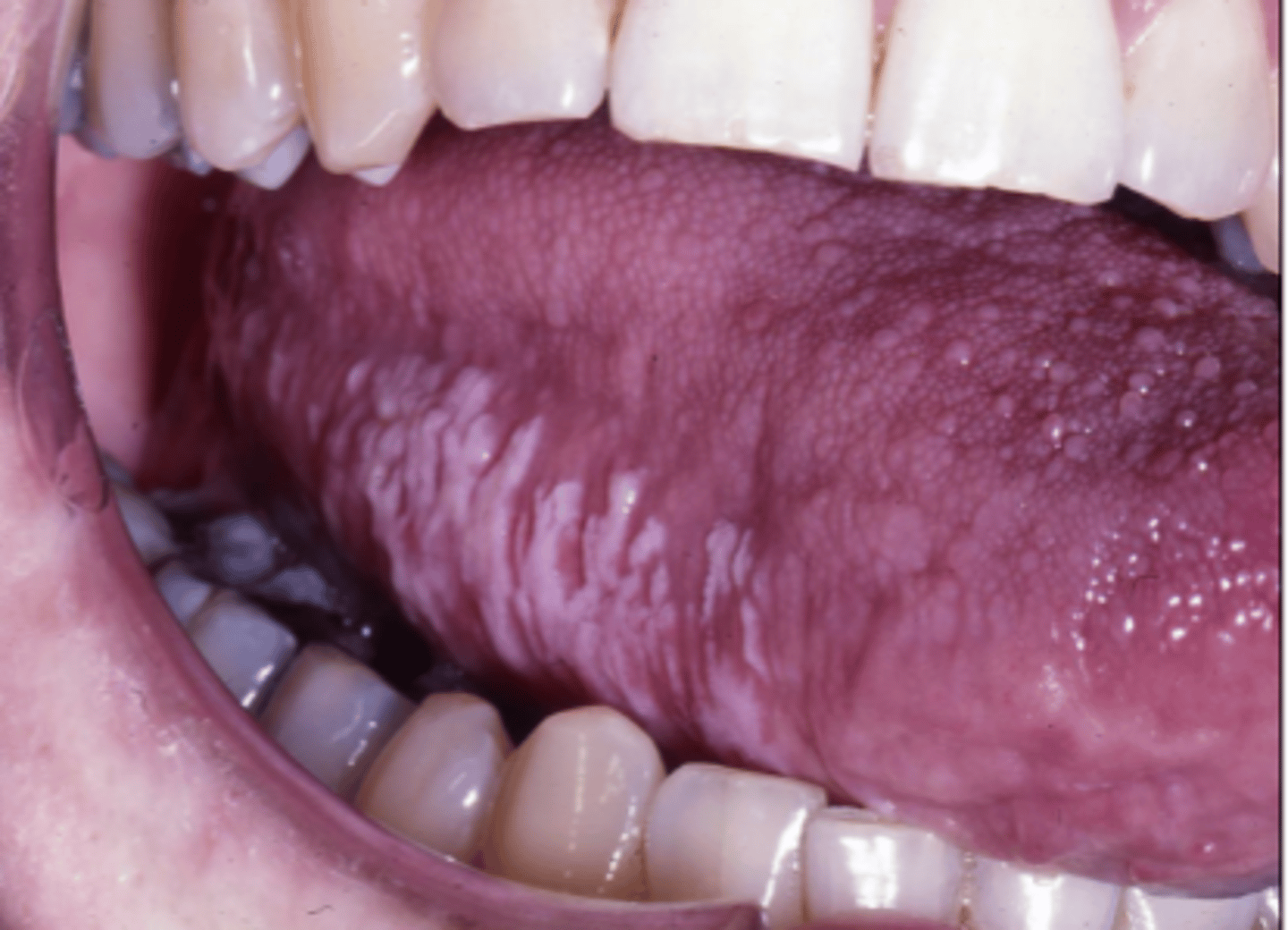 <p>Epstein-Barr Virus</p><p>- presents as non-removed white plaques of lateral tongue</p><p>- no treatment/asymptomatic</p>