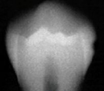 <p>caries classification?</p>
