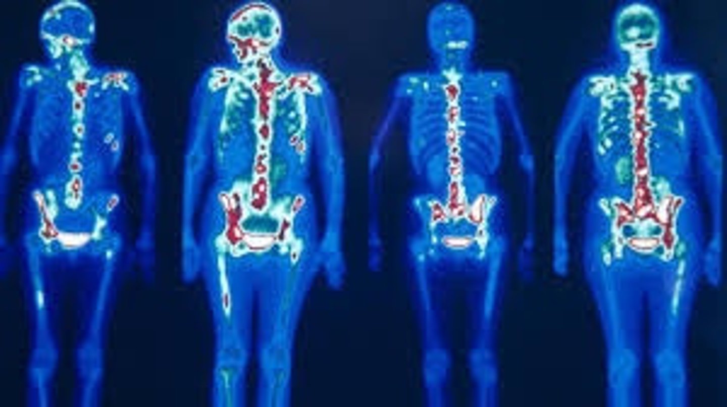 <p>Nuclear Scintigraphy</p>