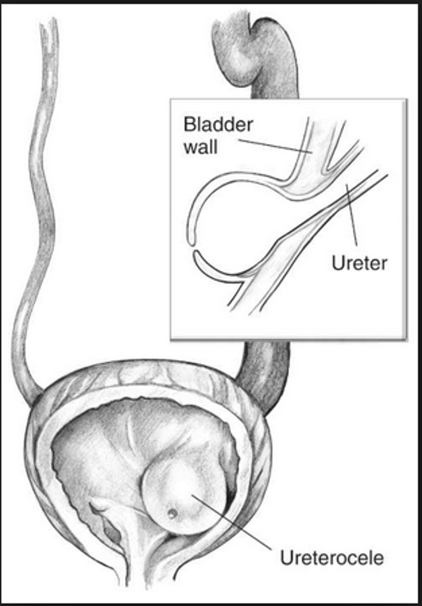 <p>protrusion of a ureter</p>