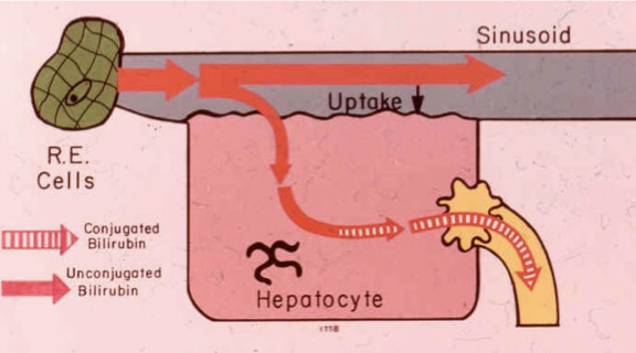 <p>A rare genetic disorder affecting bilirubin metabolism, characterized by severely elevated levels of unconjugated bilirubin due to a deficiency in the enzyme UDP-glucuronosyltransferase. </p>