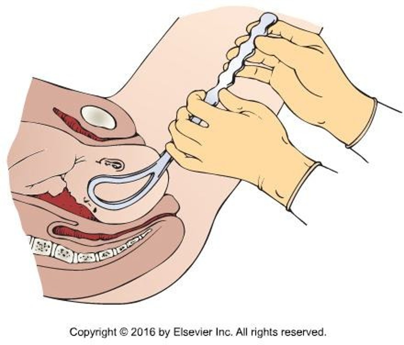 <p>Birth performed using forceps or a vacuum extractor.</p>
