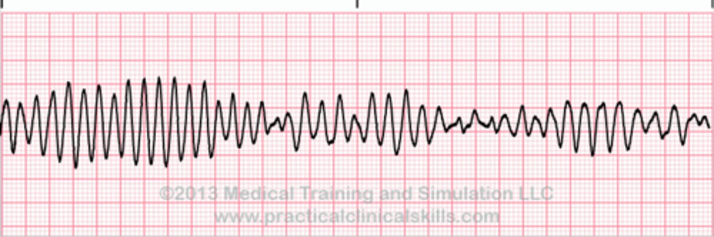 <p>Polymorphic VT associated with prolonged QT interval, can be self-terminating or progress to v-fib</p><p>causes: electrolyte imbalance (hypokalemia, hypomagnesia, hypocalcemia), QT prolonging drugs (especially classes IA antiarrhythmics), severe brady, and congenital long QT syndrome.</p><p>Tx: first line - MAGNESIUM SULFATE</p><p>Magnesium is almost always the answer</p>