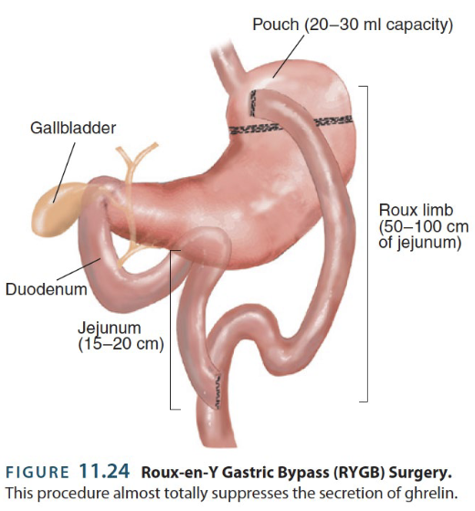 <p><strong>RYGB surgery</strong> → surgical treatment for <strong>obesity</strong> that involves mechanically limiting the amount of food that can be eaten from a meal (by modifying the GI)</p><ul><li><p>Jejenum (2nd part of small intestine) is cut and attached to top of the stomach</p></li><li><p>Stomach is stapled</p><p></p></li><li><p><u>Effectiveness</u>: Reductions in hunger overtime (but they don’t seem to be related to hormonal differences)</p></li></ul><p></p>