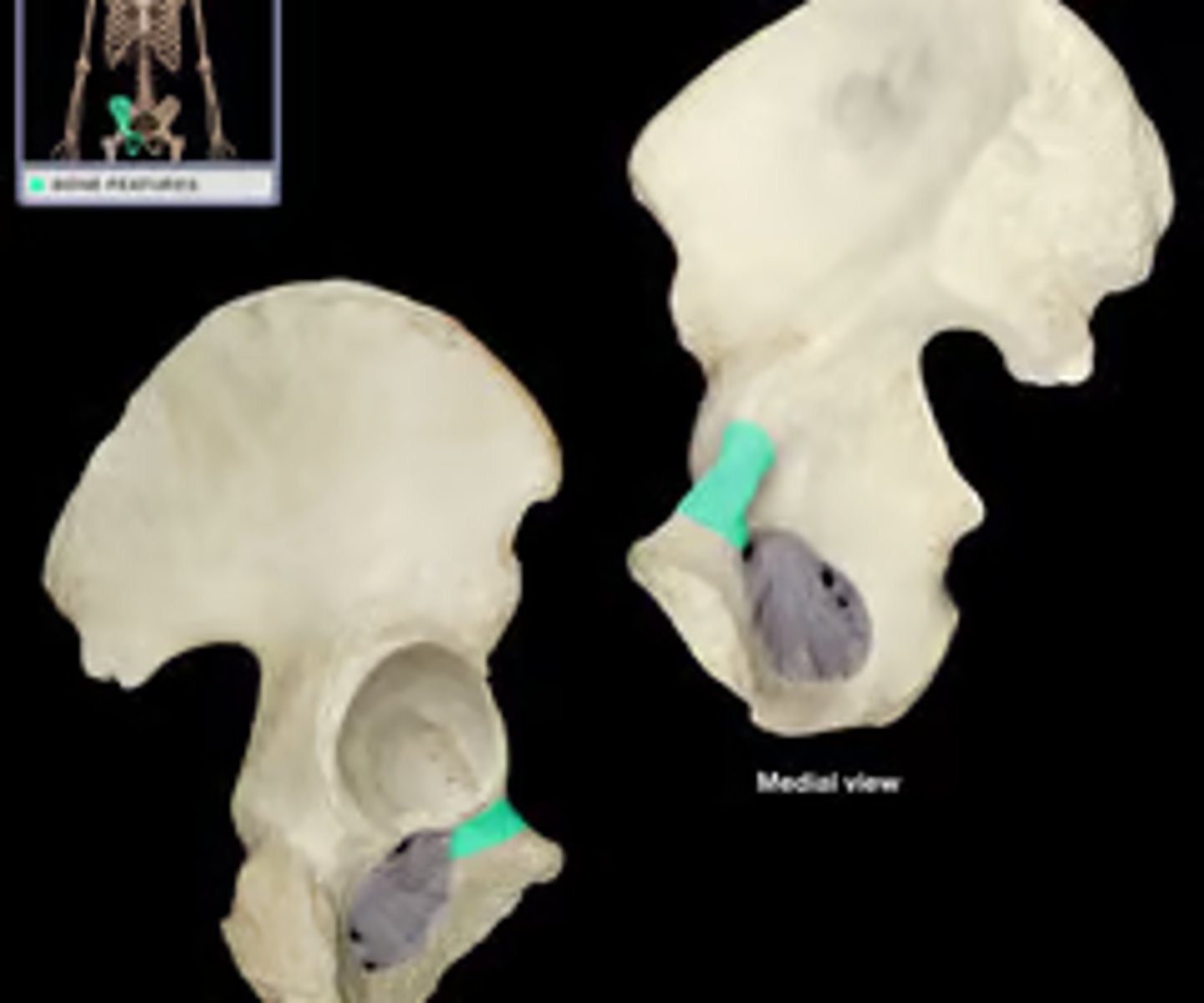<p>ridge of bone that bridges the ilium and pubis</p>