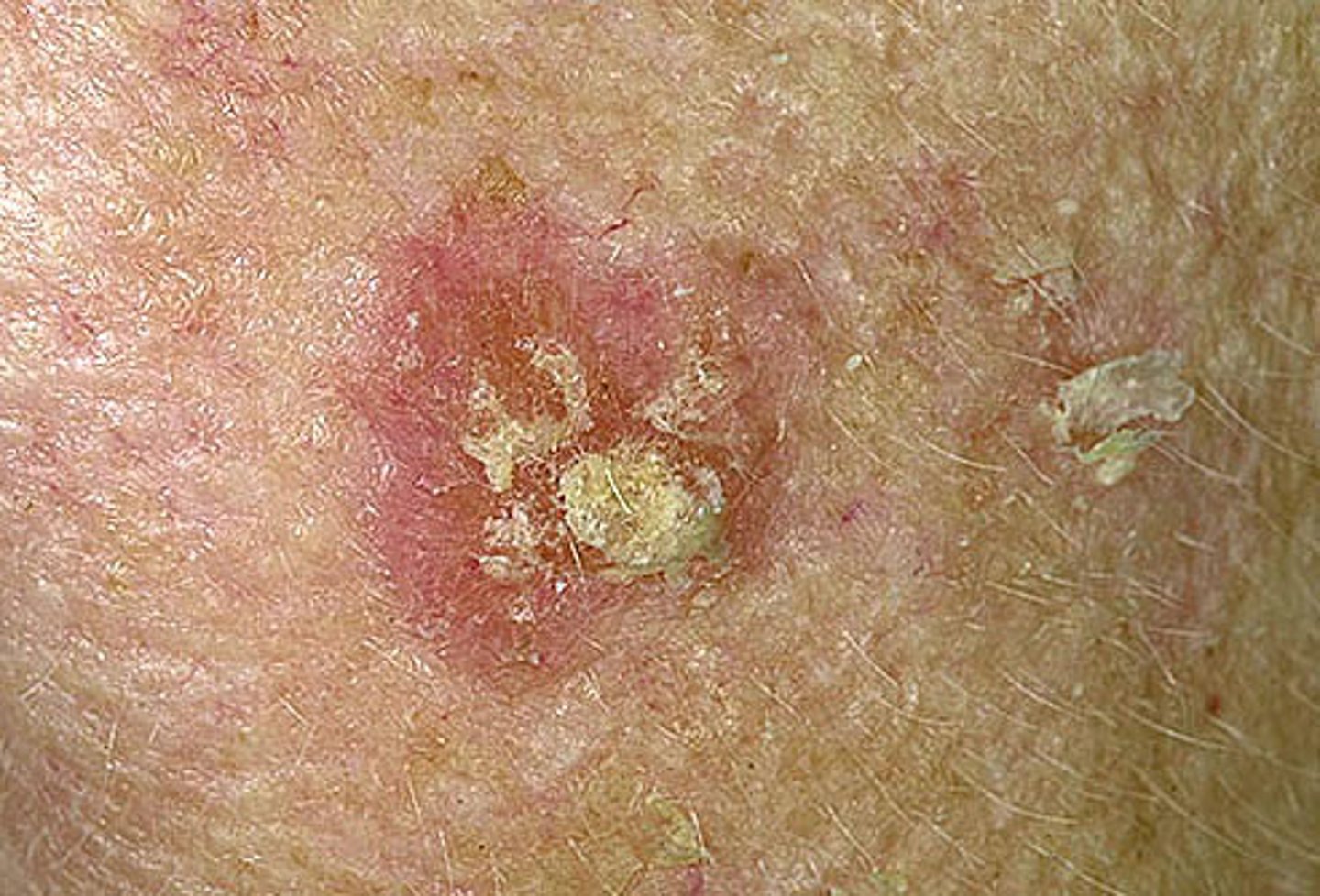 <p>A pre-cancerous lesion that is usually associated with SCC and occurs in sun-exposed areas of the skin</p>