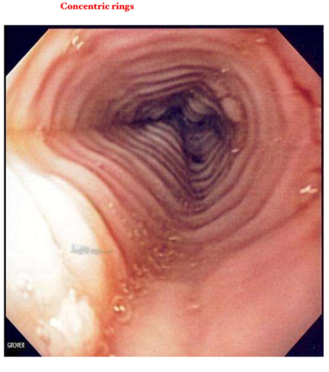 <p>1.) Endoscopy with biopsy</p><p>2.) Edema, concentric rings, exudates, furrows, and strictures</p><p>3.) CBC to determine if eosinophils are elevated. Allergen specific IgE test.</p><p>Jeremy has esinophilic esophagitis</p>