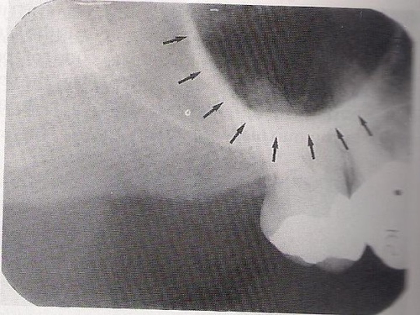 <p>U shaped; in apical region of 1st and 2nd molars</p>
