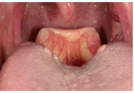 <ul><li><p>flap of tissue that closes opening to the larynx and trachea </p></li></ul><p></p>