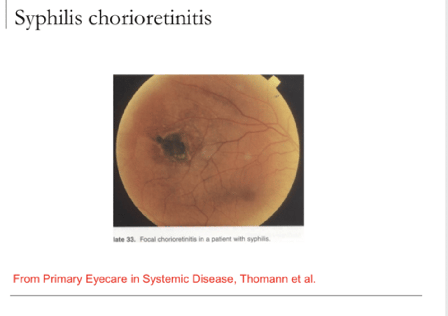 <p>Syphilis -- Chorioretinitis (Pic)</p>