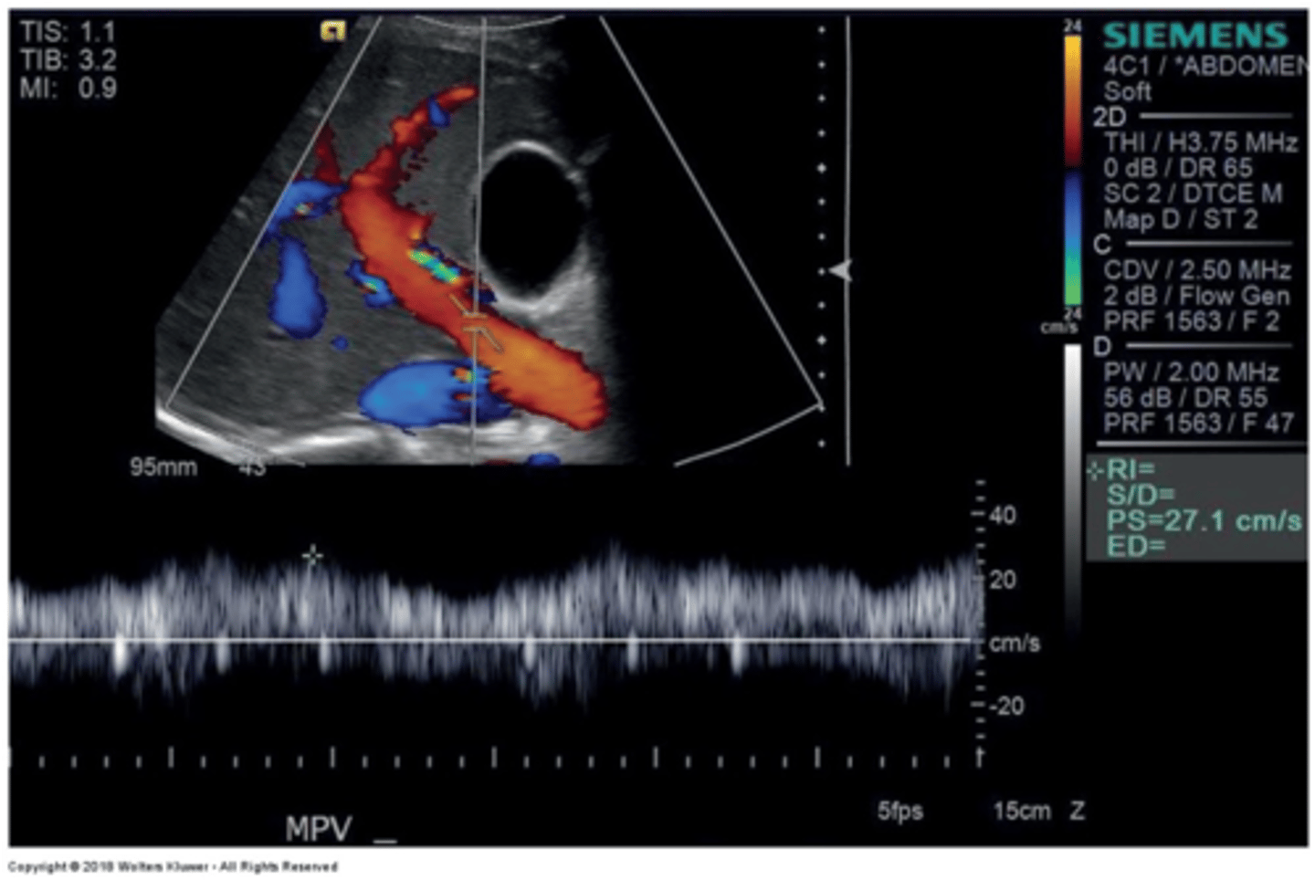 <p>Monophasic continuous waveform</p><p>Hepatopetal flow (antegrade flow)</p>