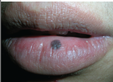 <p><span>A flat lesion &lt;1 cm in size without elevation or depression</span></p>