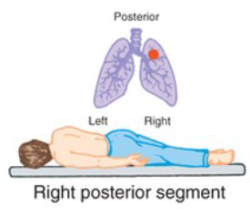<p>What CPT position is pictured, and when is it used?</p>