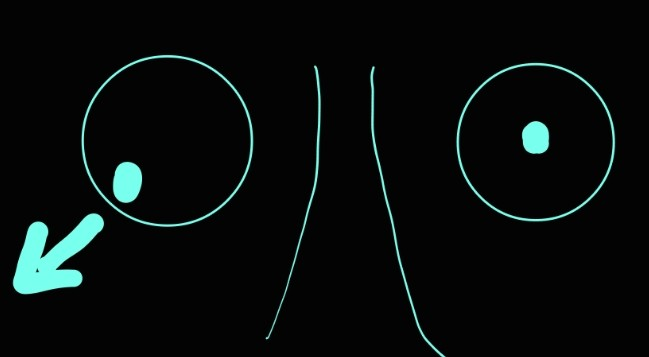 <p>superior oblique muscle </p>