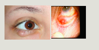 <p>chalazion</p>