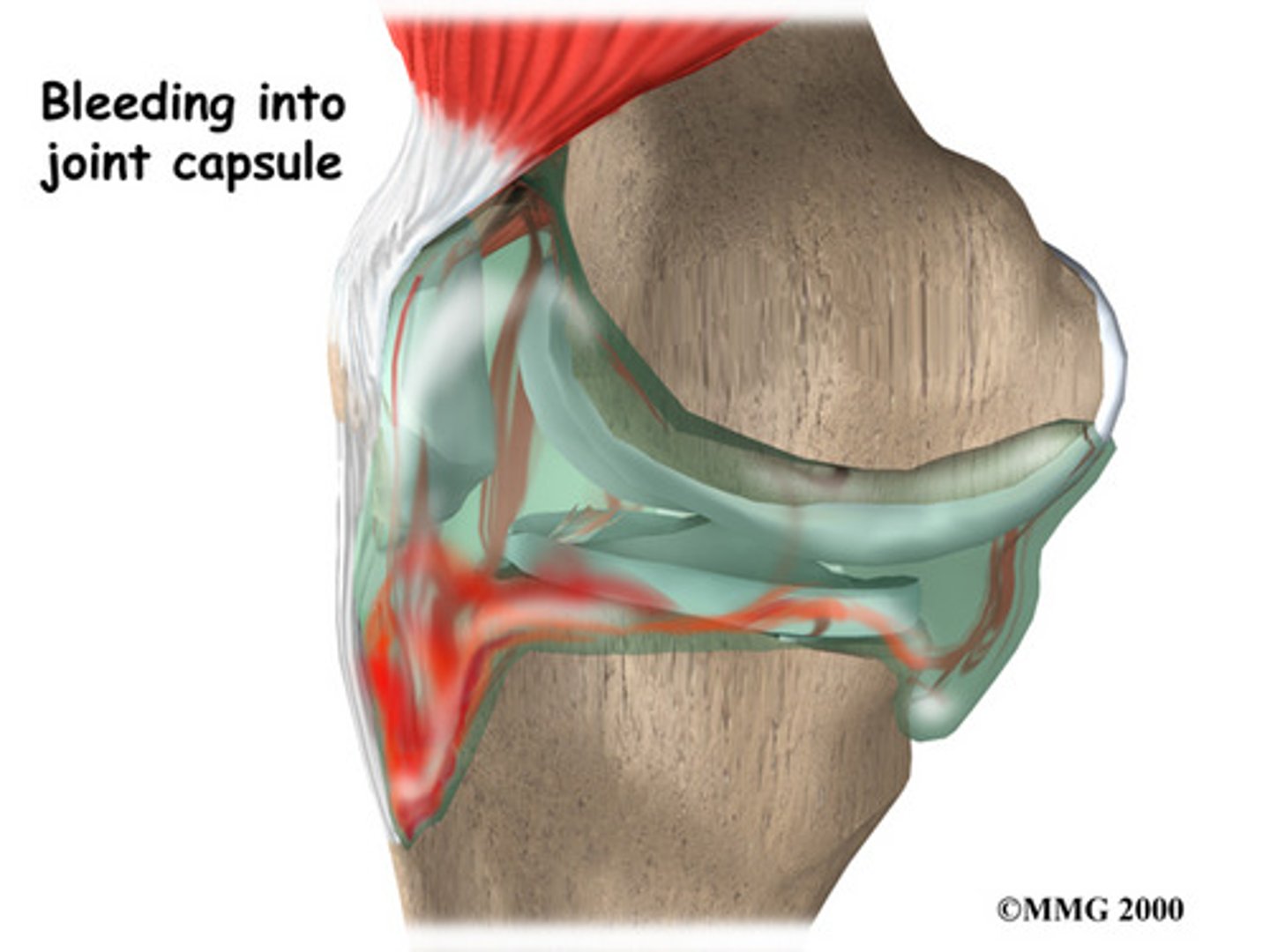 <p>Blood within a joint.</p>