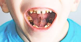 <p>describe childs mouth with caries - talk about the impact of it and whats the gov can do to solve issues in childrens oral health</p>