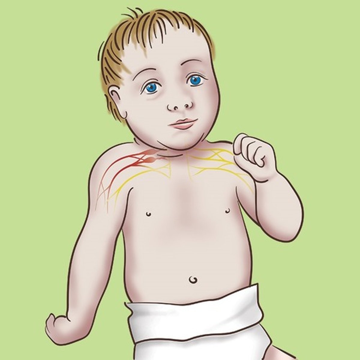 <p>Erb's palsy</p><p>MOI - increased angle between neck and shoulder, traction to the brachial plexus</p><p>- Scapular depression, internal rotation, wrist flexion</p>