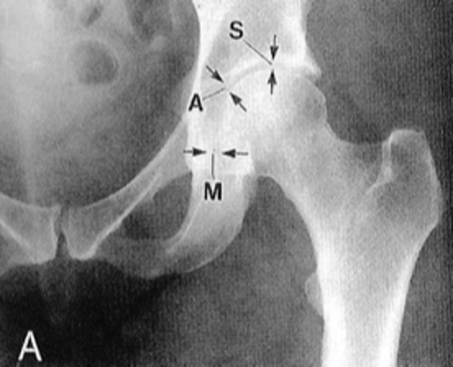 <p>Normal axial hip joint space width</p>