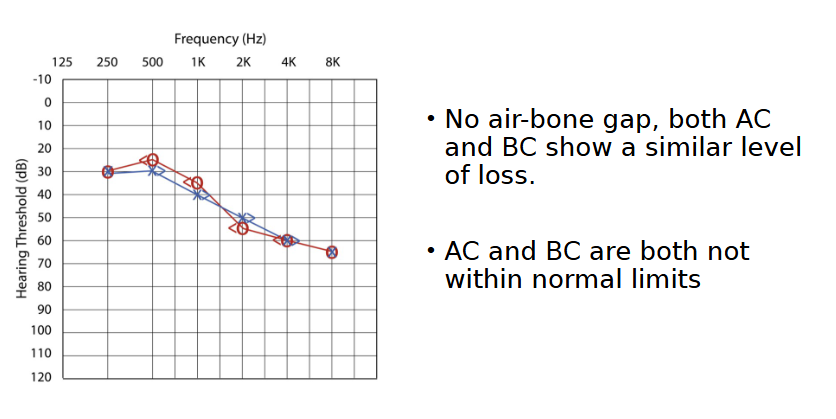 <p>“Mild sloping to moderately severe sensorineural hearing loss bilaterally”</p>