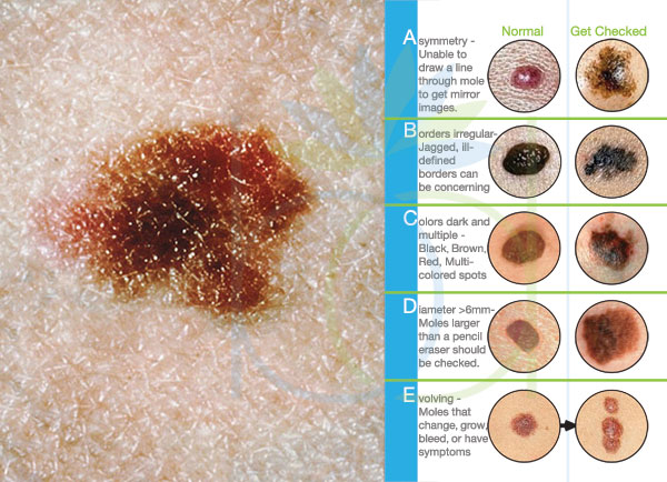 <p>5-10% has at least 1 atypical nevus</p><p>increased number→increased melanoma risk</p><p><u>ABCDE rule:</u><br><strong>A</strong>symmetry<br><strong>B</strong>order irregularity<br><strong>C</strong>olor variation<br><strong>D</strong>iameter (greater than 6mm+)<br><strong>E</strong>volution</p><p><u>history:</u><br>especially past bleeding/ulceration hx<br>single most historical reason for close eval/referral</p><p><u>biopsy:</u><br>shave biopsy<br>punch biopsy<br>moderately atypical→normal removal/monitoring<br>severely atypical→remove with 5mm margins</p>