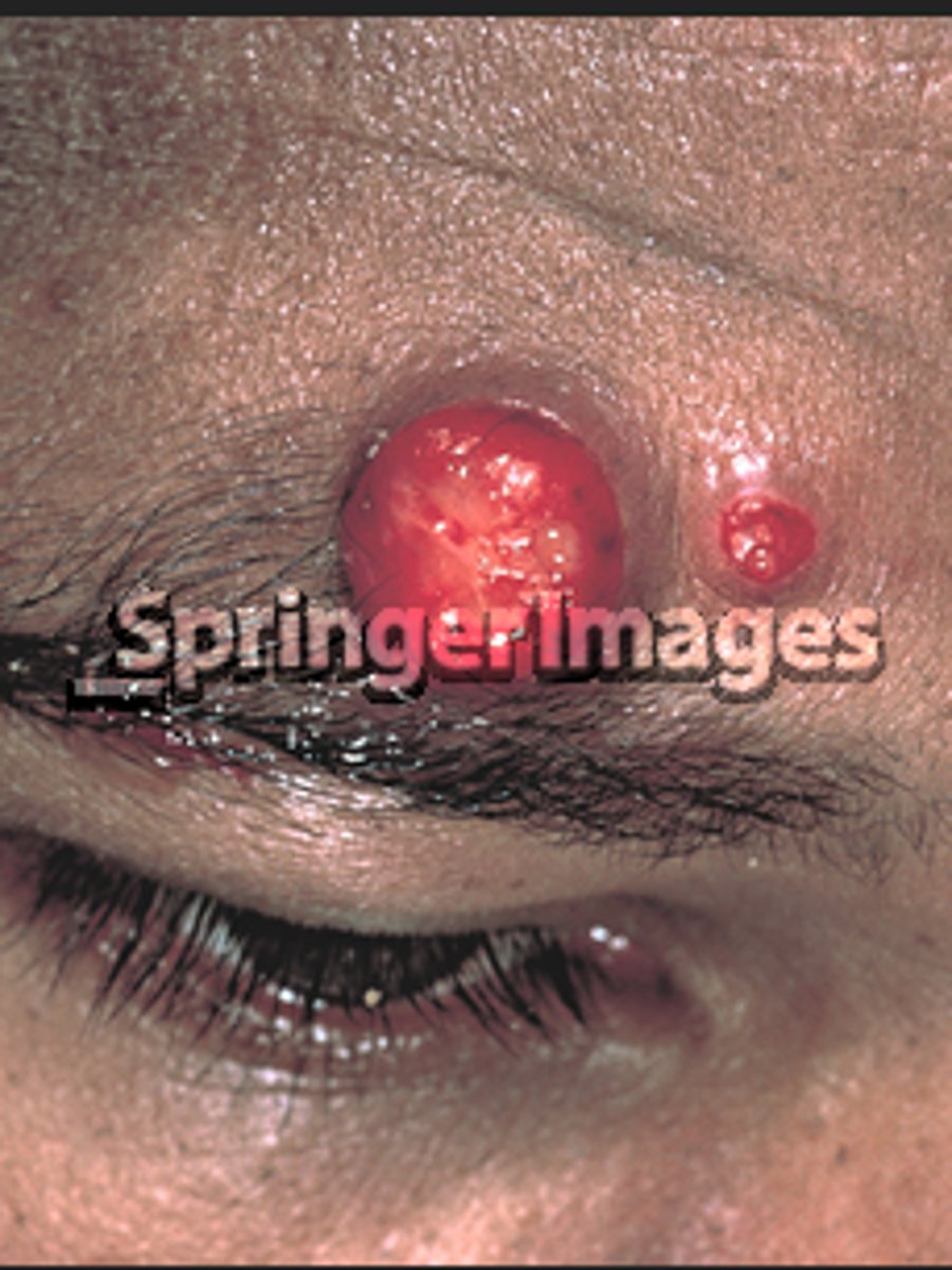 <p>Bacillary angiomatosis</p><p>- Bartonella, gram negative bacillus</p><p>Oral erythromycin</p>