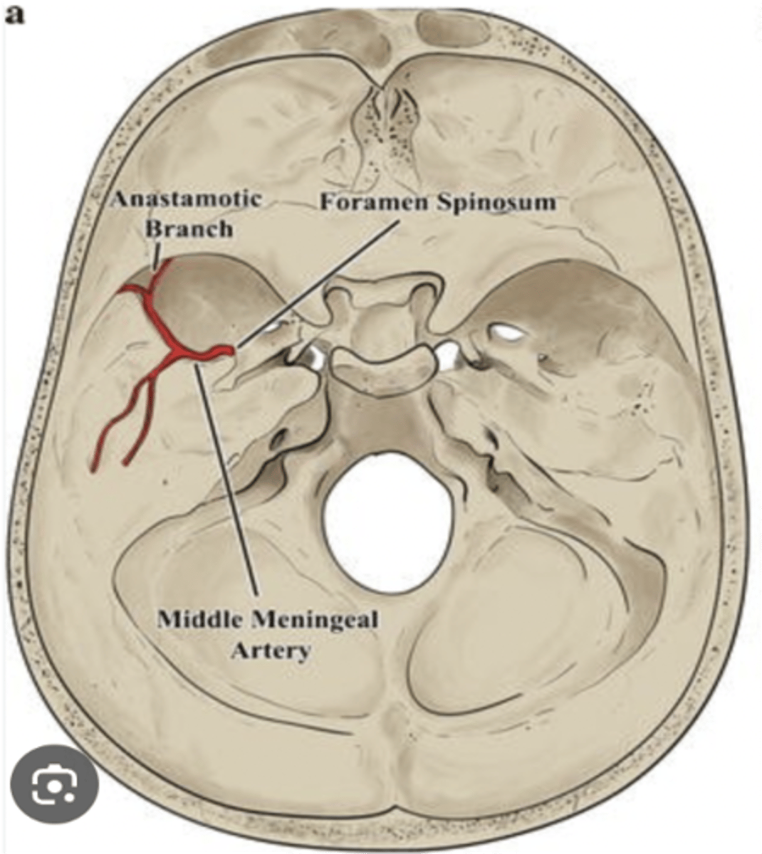 <p>Middle meningeal artery</p>