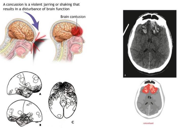 <p>(Hemorragische) contusiehaarden / grijzestofletsels</p>