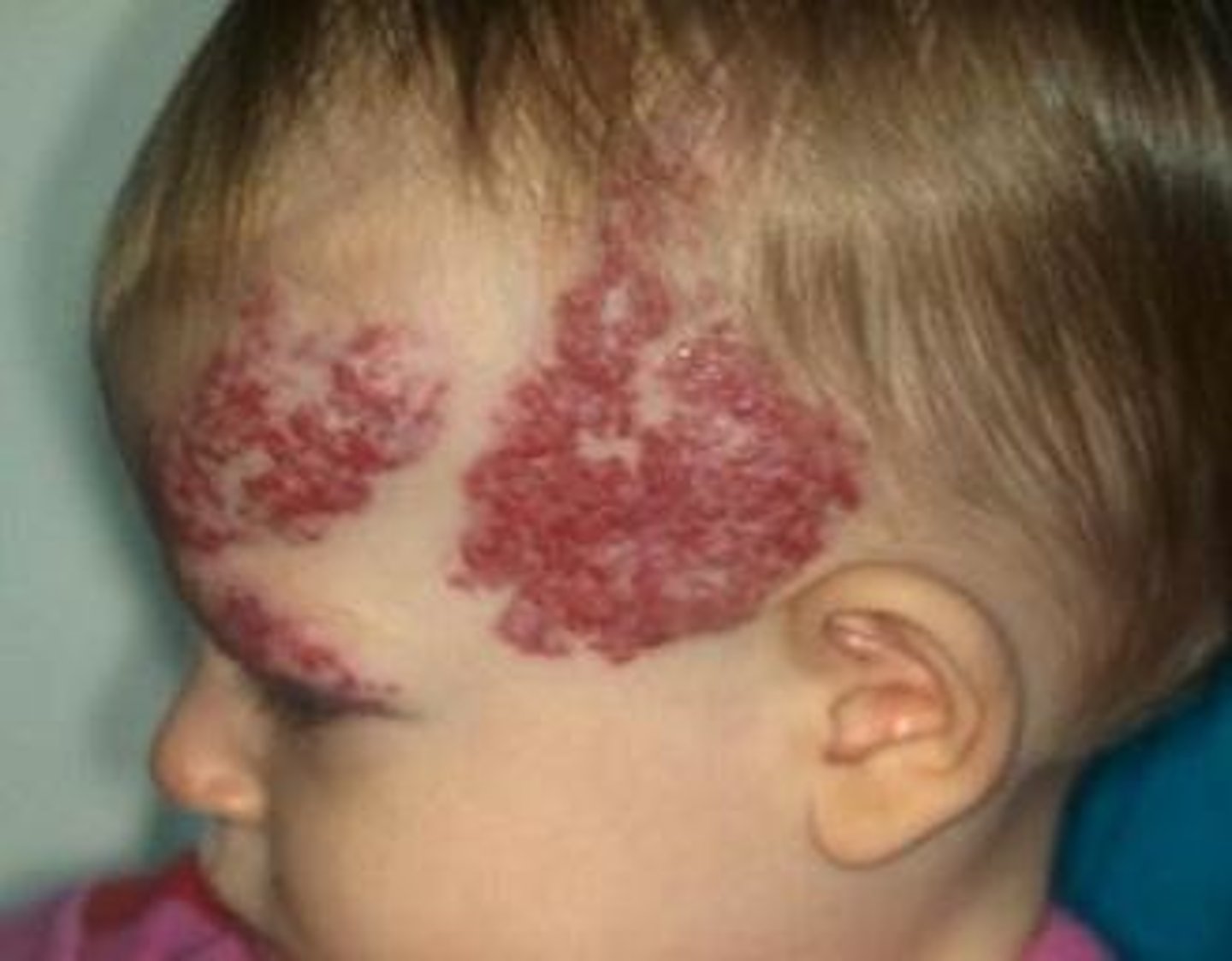 <p>-congenital, soft and spongy</p><p>-can contain alot of blood</p><p>-first few weeks of life, gone by age 9</p><p>head, neck, viscera, liver, pancreas</p>