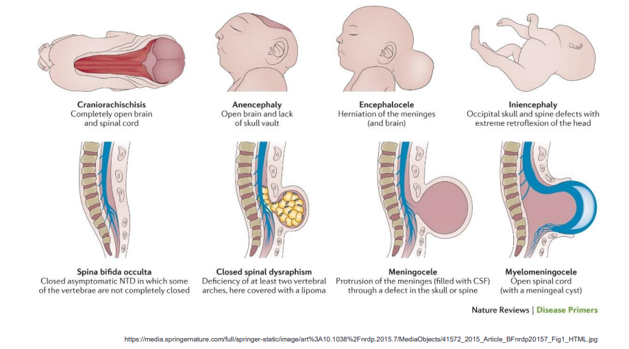 <p><strong><mark data-color="yellow" style="background-color: yellow; color: inherit;">backbone and spinal canal</mark></strong> do not form properly in the developing fetus </p>
