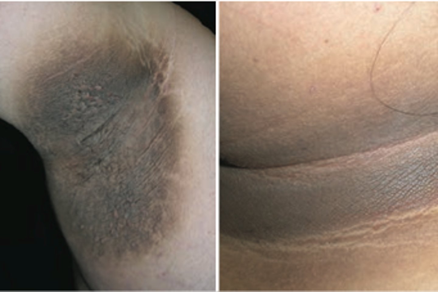 <p>d. Ask the patient about type 2 diabetes or if there is a family history of it.</p><p>The presence of acanthosis nigricans in skinfolds suggests either having type 2 diabetes or being at an increased risk for it. The description of the patient's skin does not indicate problems with fungal infection, poor hygiene, or the need to dry the skinfolds better</p>