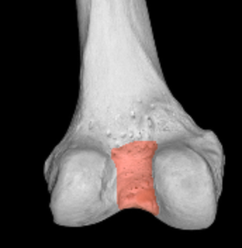 <p><strong>posterior</strong> indent between condyle of femur</p>