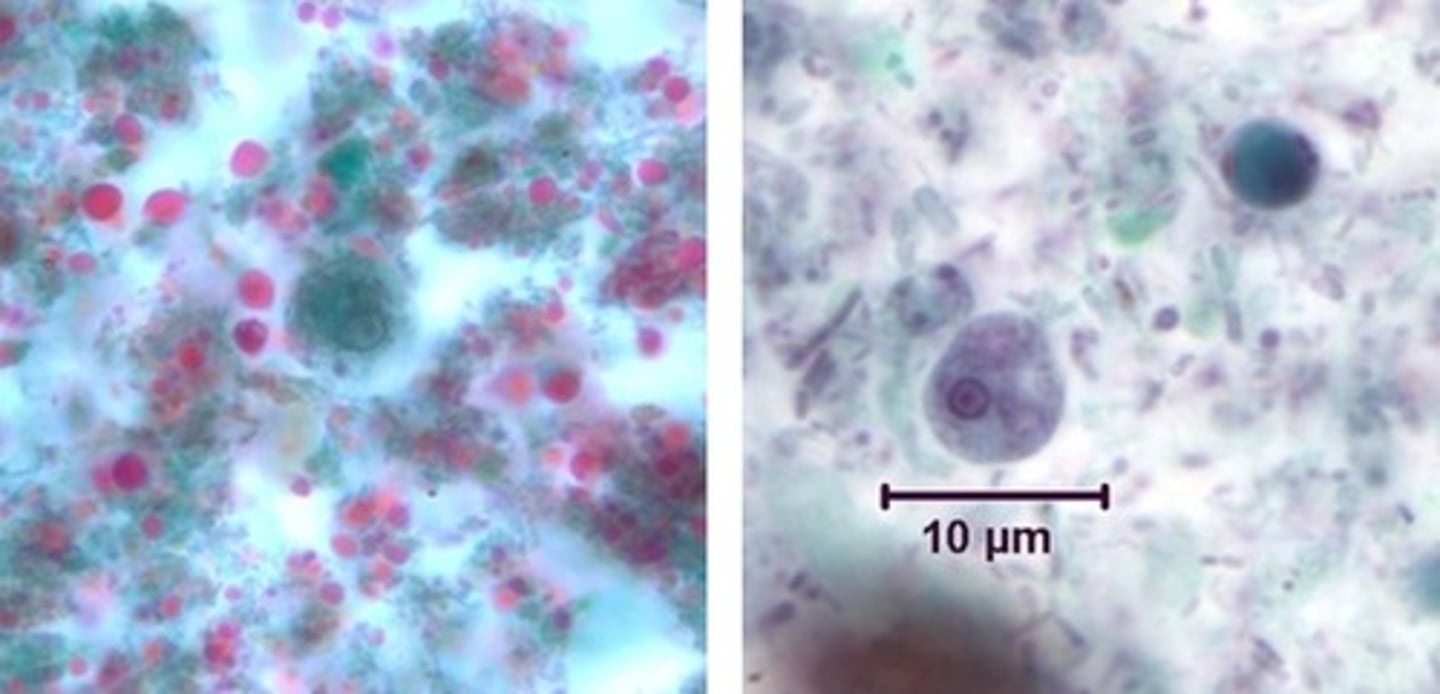 <p>• Cyst (left)</p><p>o Looks like</p><p>aminiature E.hist</p><p>olytica</p><p>o Up to 4 nuclei</p><p>• Trophozoite (right)</p><p>o 5-10 microns</p><p>o Looks like a</p><p>miniature E.</p><p>histolytica</p><p>o No ingested</p><p>RBCs</p>