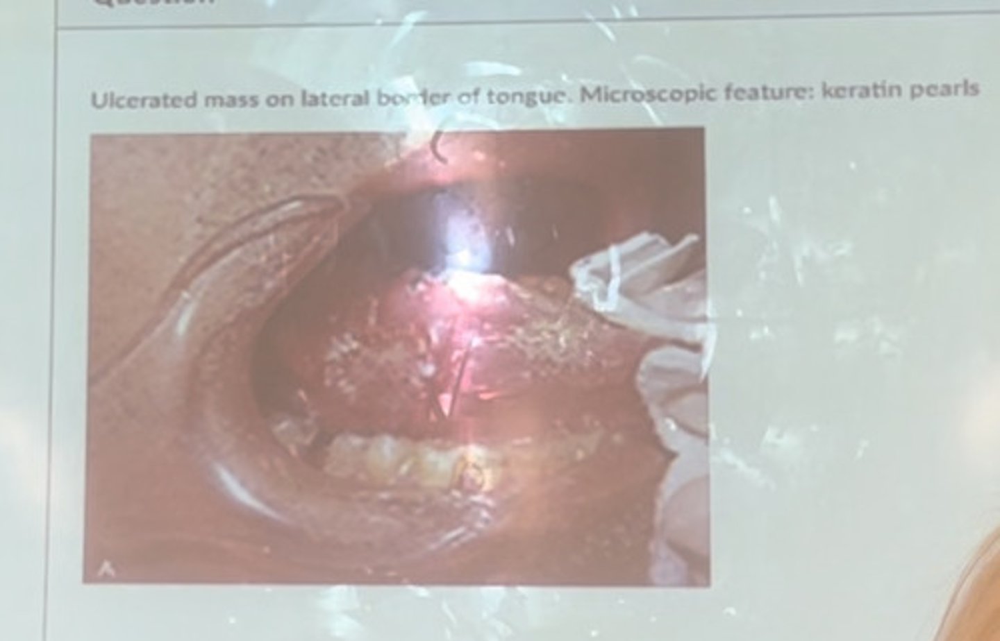 <p>Ulcerated mass on lateral border of tongue. Microscopic feature: keratin pearls.</p>