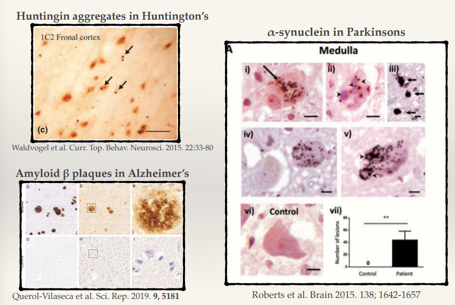 <p>They have different kinds of symptoms </p><ul><li><p>Different types of neurones are particularly sensitive to different types of proteins</p></li><li><p>Could be a combination of how heavily these proteins are expressed in different regions of the brain or how highly expressed the genes that are causing the underlying diseases are.</p></li></ul><p></p>