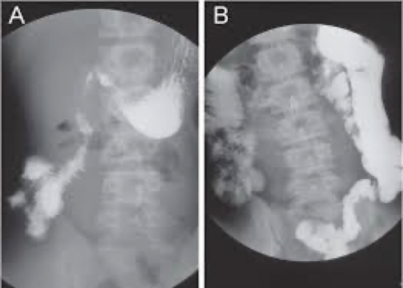 <p>congenital and can cause obstruction</p>