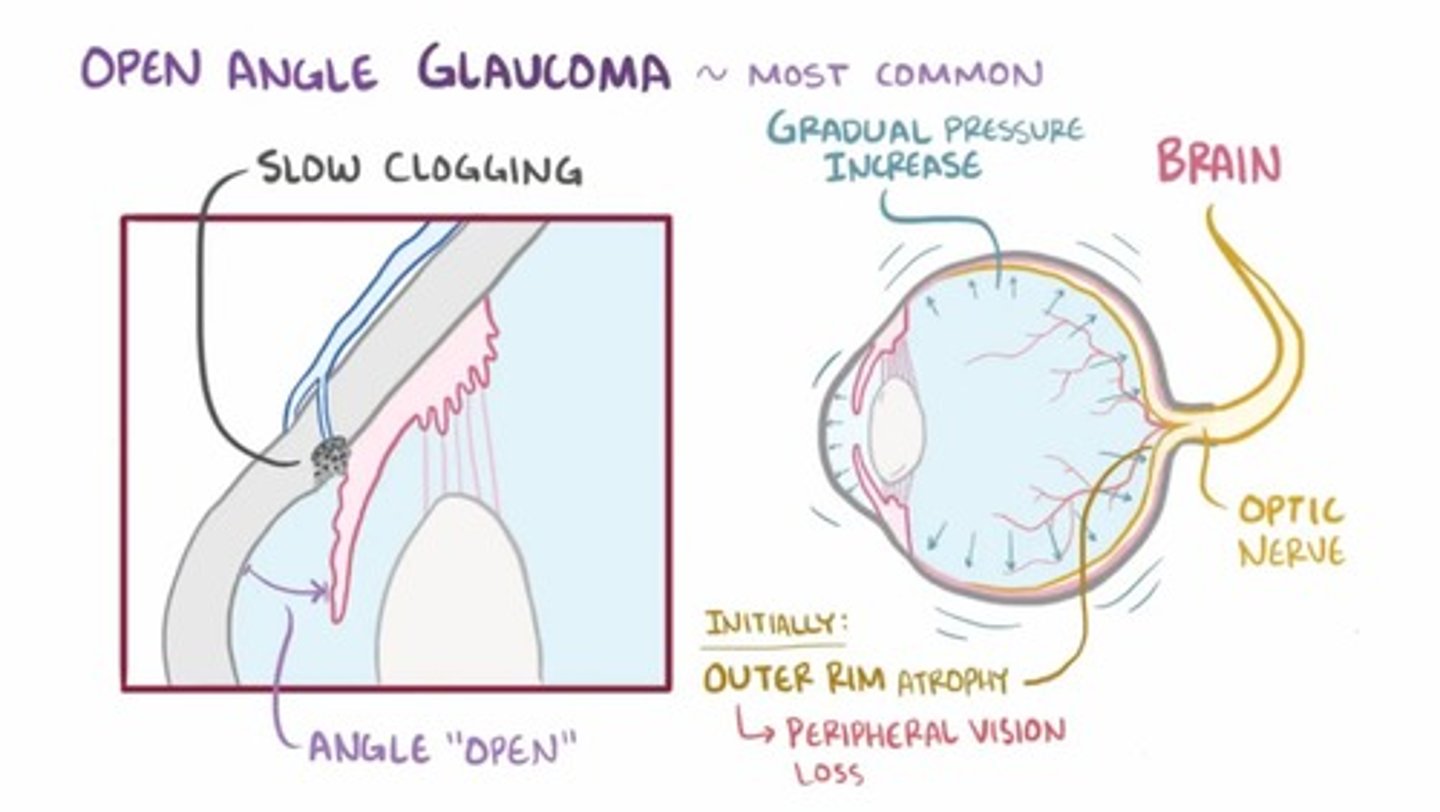<p>When trabecular meshwork and canal of Schlemm becomes blocked (so no drainage of AH), therefore there is a build up of aqueous humour (AH) leading to a rise in intra-ocular pressure.</p><p>- this is the most common cause of glaucoma</p>
