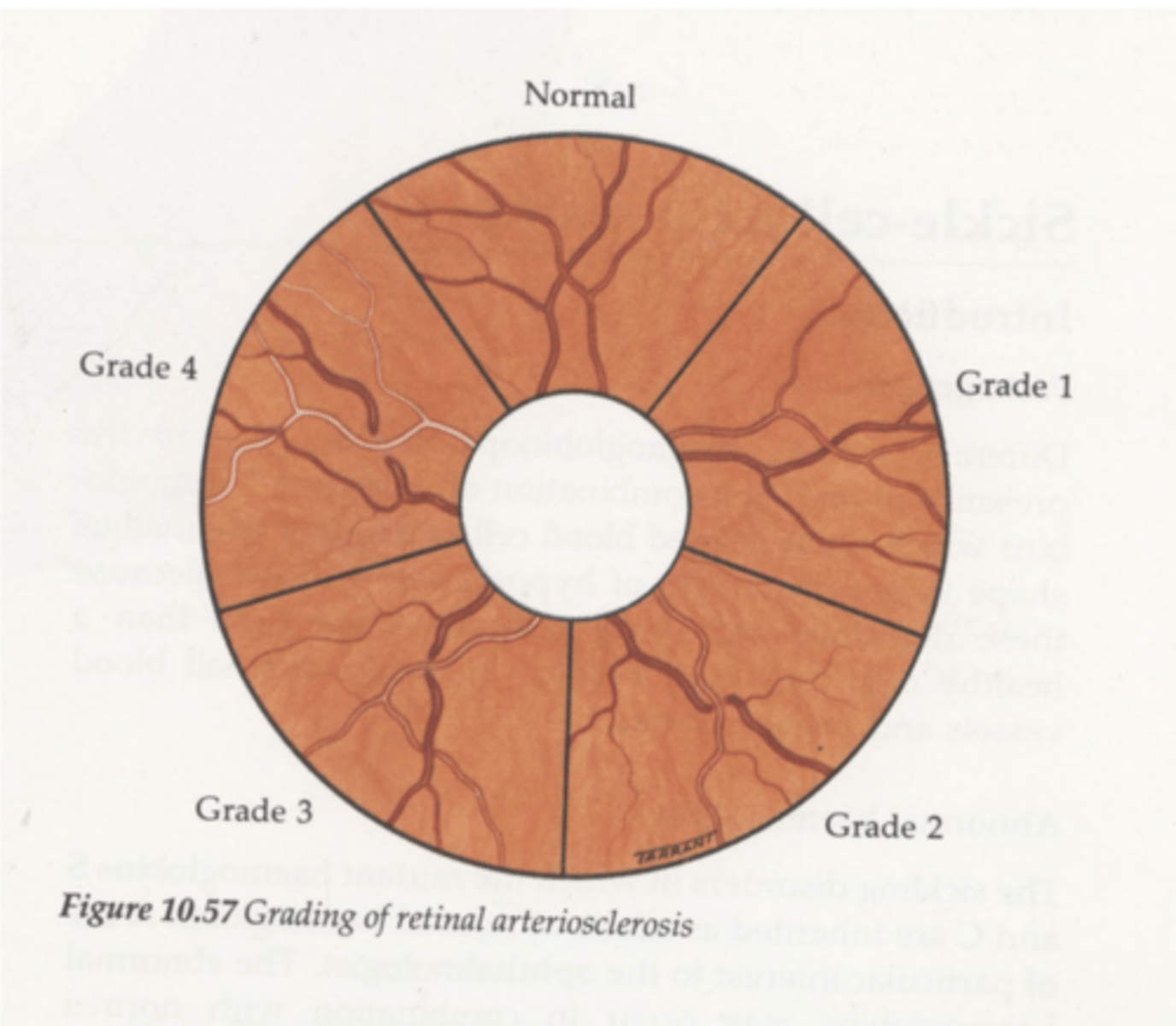 <p>narrowing of arteries</p><p>widening of light reflex d/t thickening of walls</p>