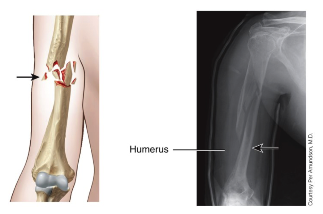 <ul><li><p>in humerus </p></li><li><p>splintered/crushed or broken into pieces </p></li><li><p>bone fragments are present at site of fracture </p></li></ul>