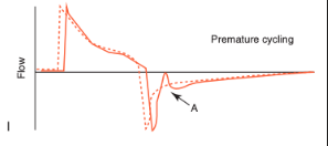 <ul><li><p><span>Patient is continuing to make inspiratory efforts at the time the ventilator cycles off</span></p></li><li><p><span>May be associated with double-triggering if the inspiratory efforts are sufficient to trigger a second breath after the first has been terminated</span></p></li><li><p><span>May be detected by visualizing an abrupt initial reversal in the expiratory flow waveform (often with a concurrent concavity in the pressure waveform)</span></p></li><li><p><span>Increasing I-time or tidal volume should address premature termination</span></p></li></ul><p></p>